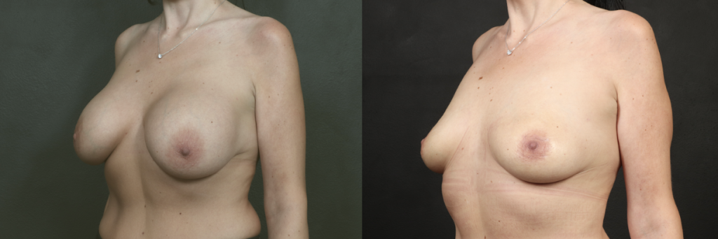 Before and After of Perkylift after breast implant removal example 1