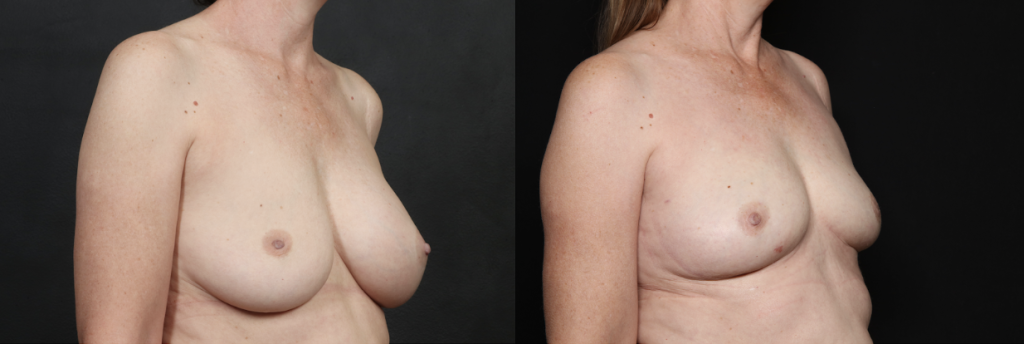 Before and After of Perkylift after breast implant removal example 2