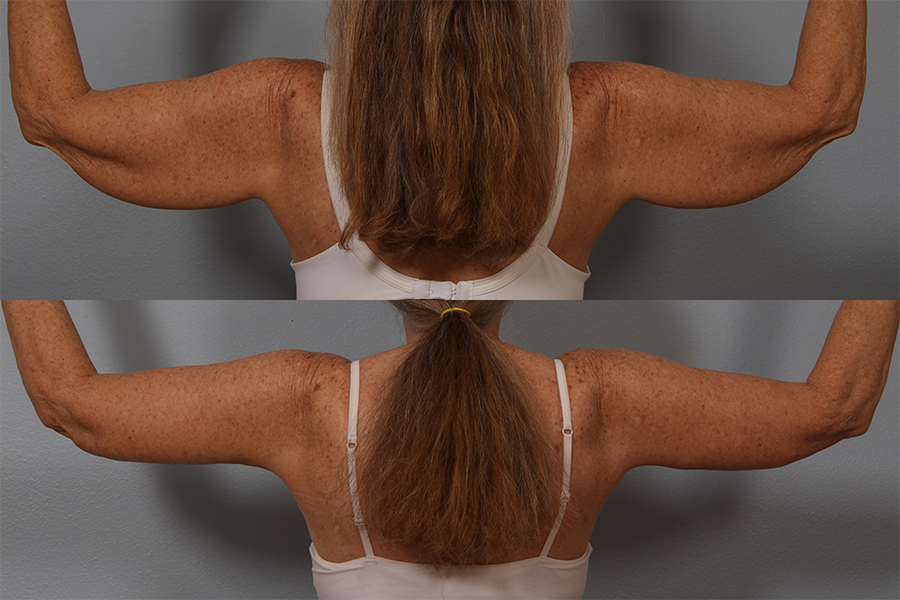 Jiggly Flabby Arms Reduced With Laser Liposuction - Body Envi