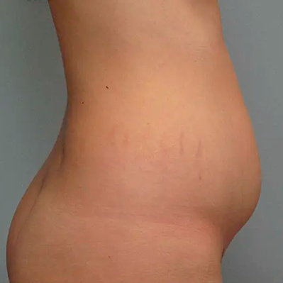 Back Contouring  Cosmetic Plastic Surgery Institute