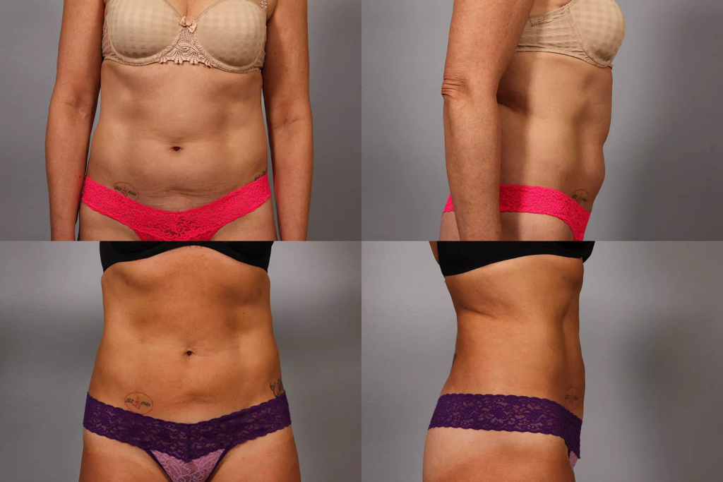 Abdominal plastic surgery and liposuction to achieve a toned abdomen